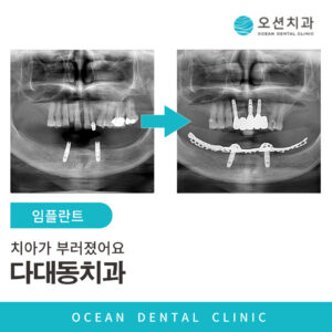 오션치과 임플란트