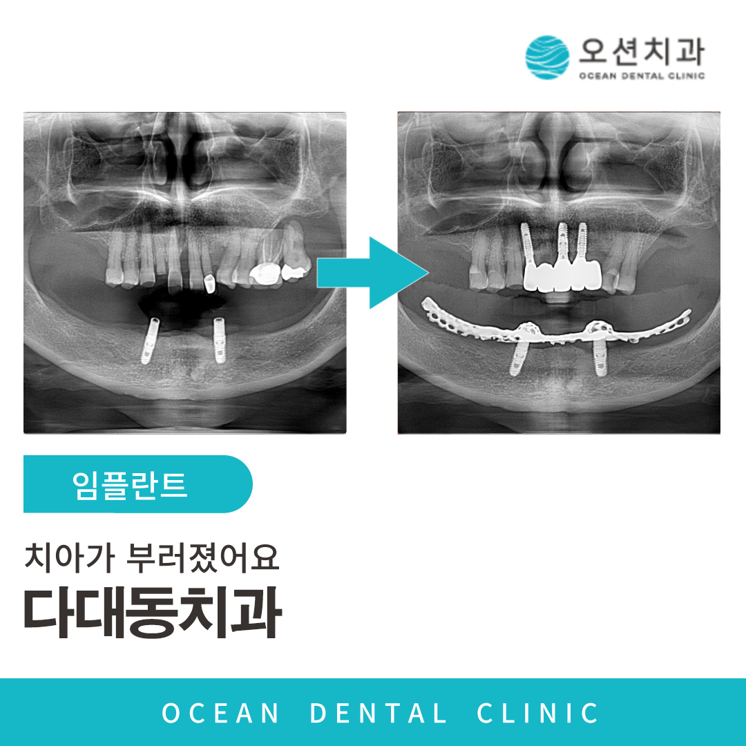 오션치과 임플란트