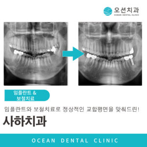 오션치과 임플란트