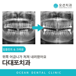 오션치과 임플란트