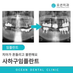 오션치과 임플란트