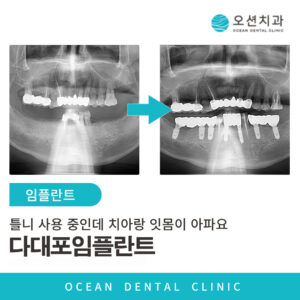 오션치과 임플란트