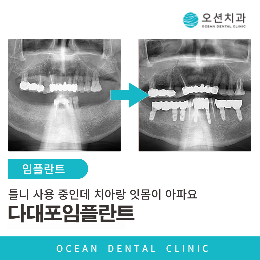 오션치과 임플란트