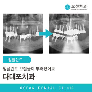 오션치과 임플란트