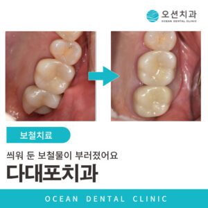 오션치과 보철치료