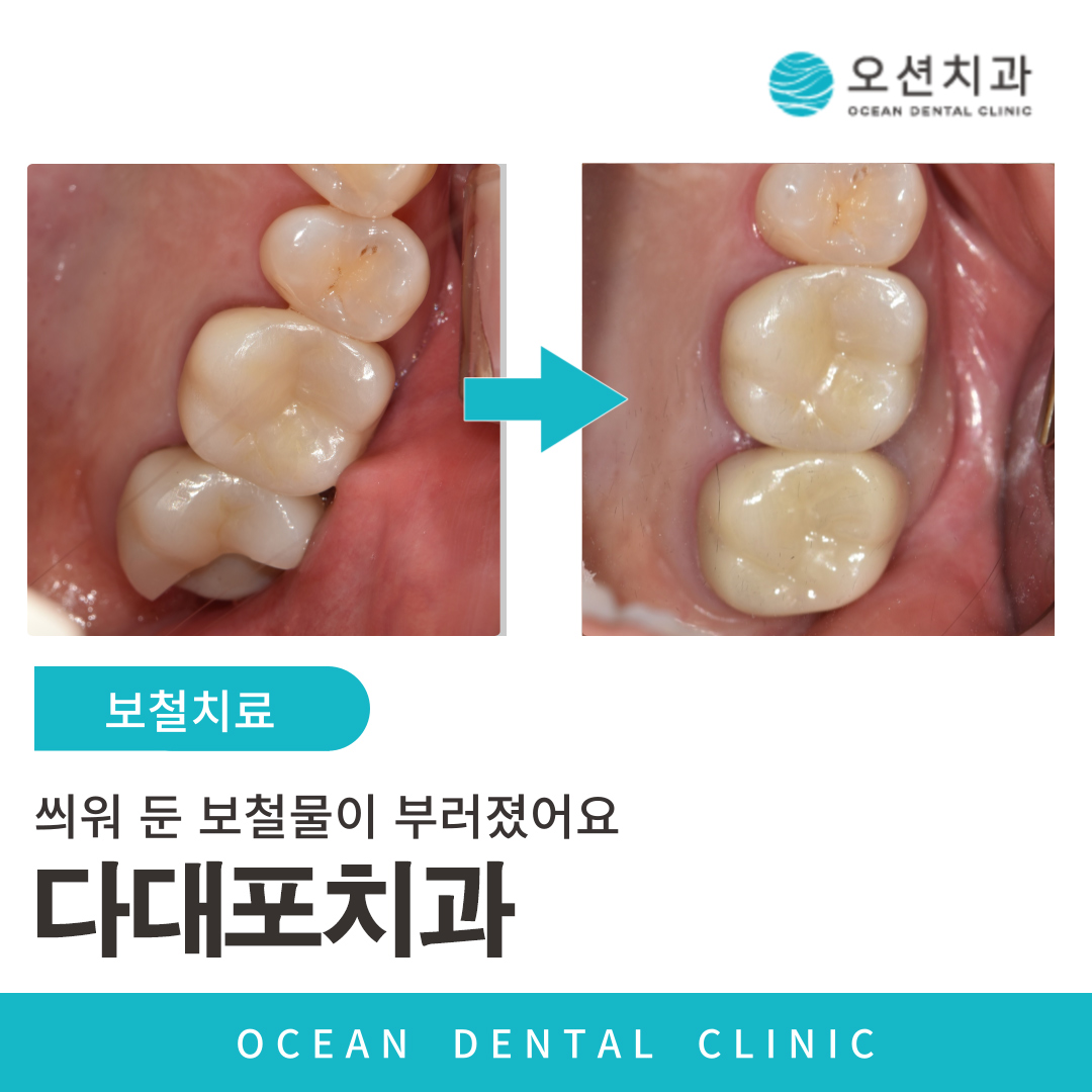 오션치과 보철치료