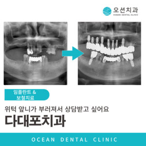 오션치과 임플란트