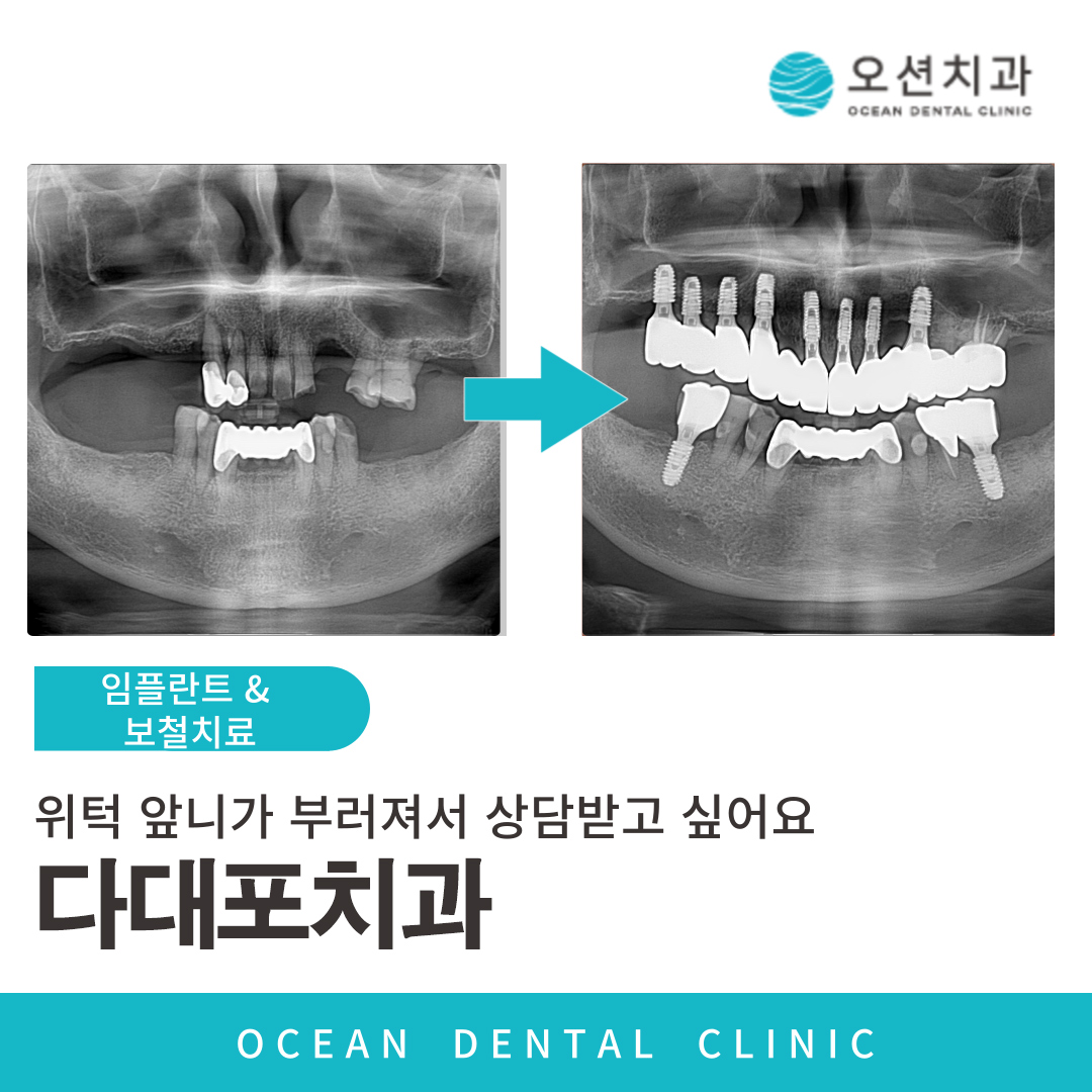 오션치과 임플란트