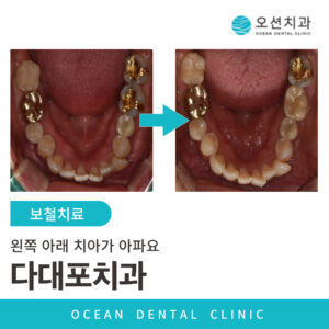오션치과 보철치료