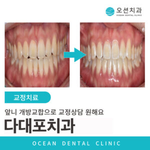 오션치과 치아교정