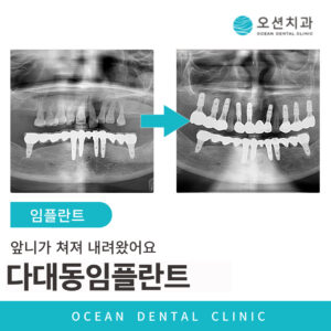오션치과 임플란트