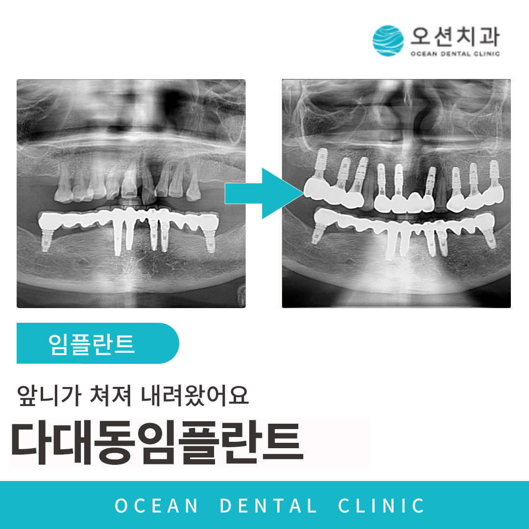 오션치과 임플란트