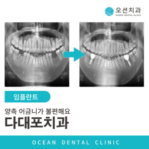 오션치과 임플란트