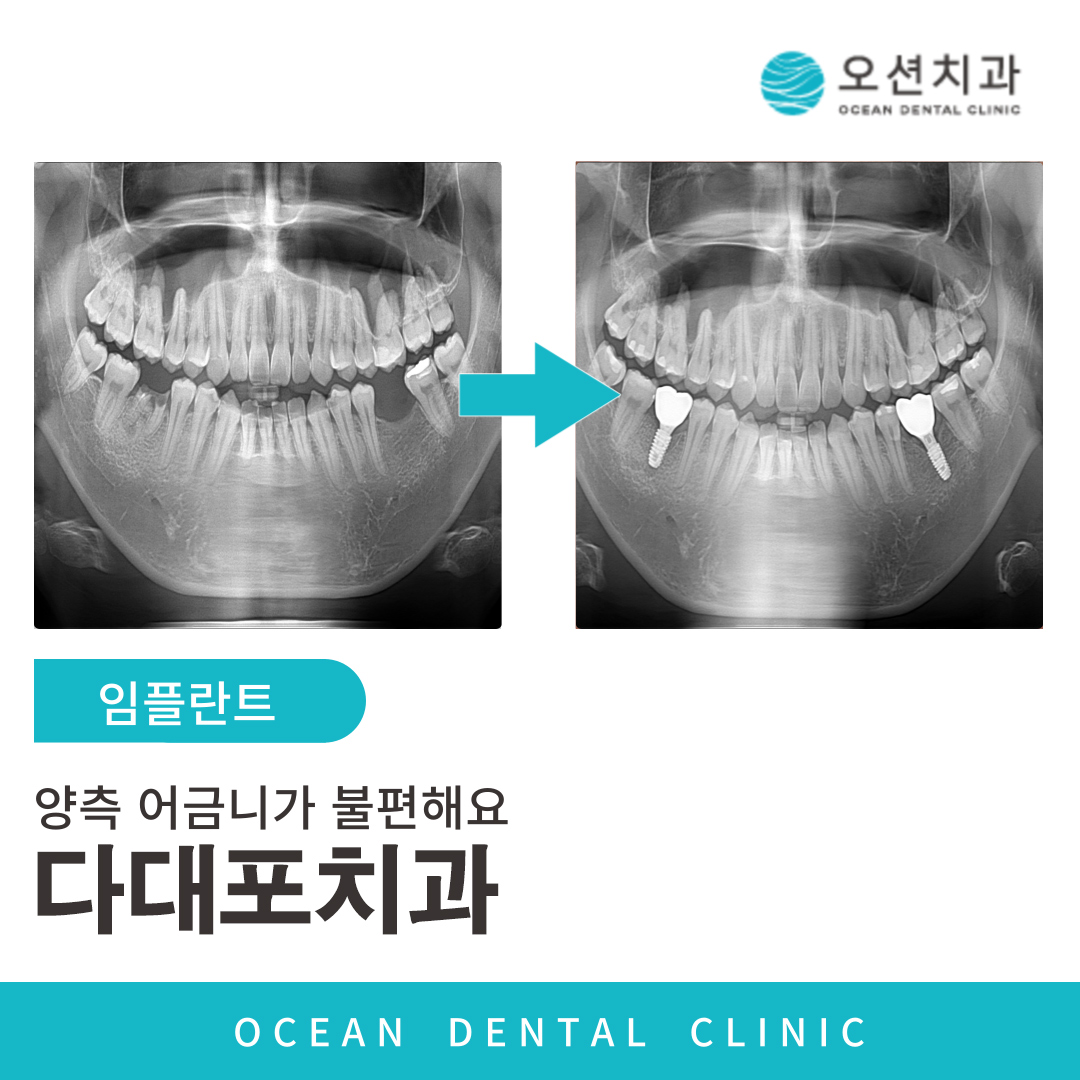 오션치과 임플란트
