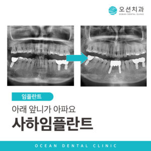 오션치과 임플란트