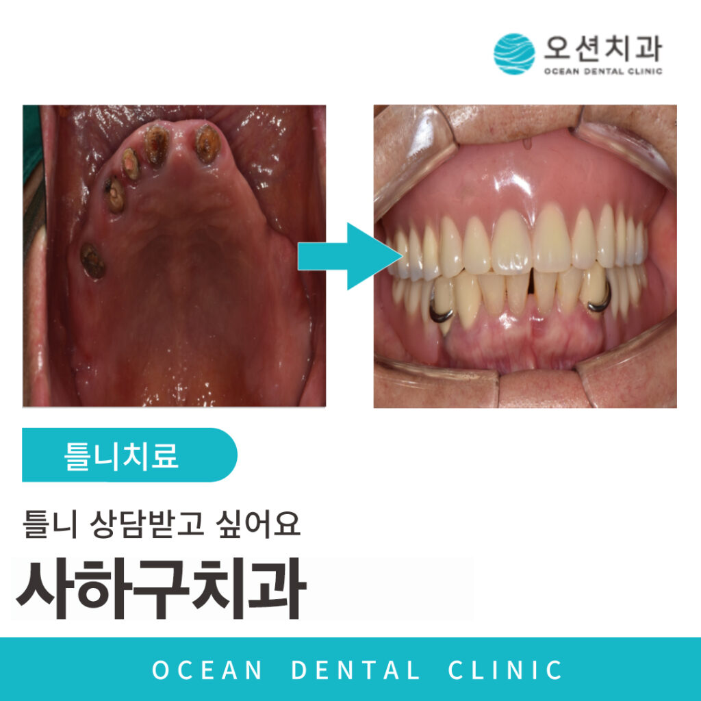 오션치과 틀니치료