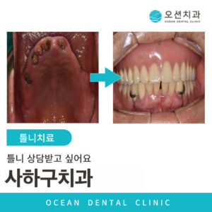 틀니치료 표지