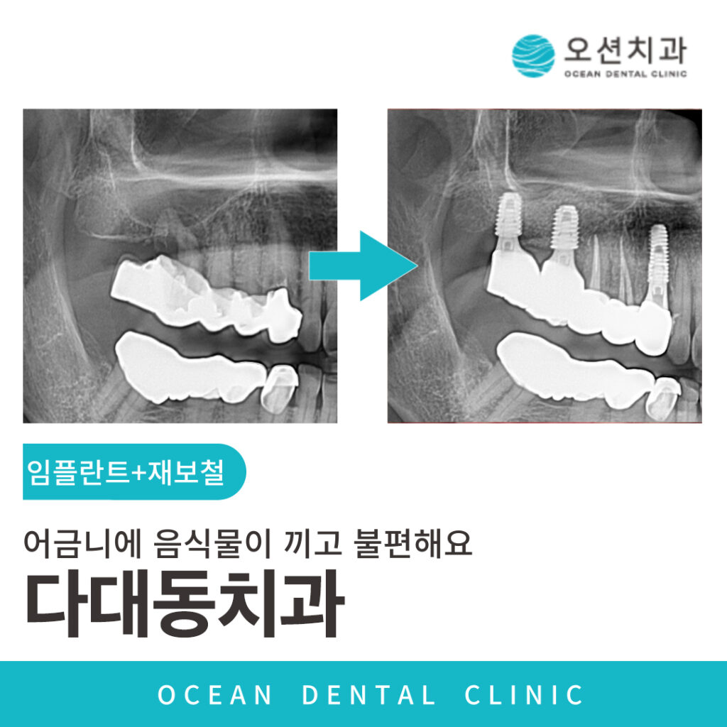 오션치과 임플란트