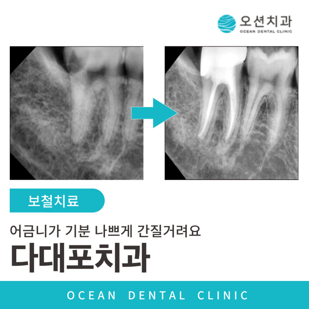 오션치과 충치치료