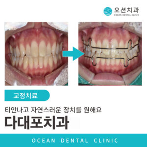 치아교정 표지