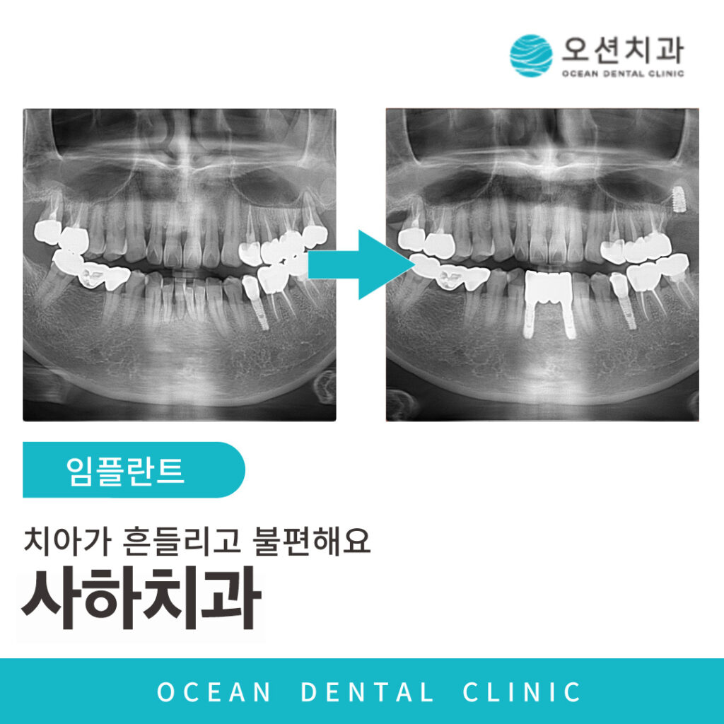 오션치과 임플란트