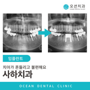임플란트 표지