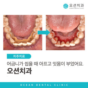 #23.02.08 오션치과_포스팅용이미지_정방향 복사