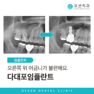 다대포임플란트