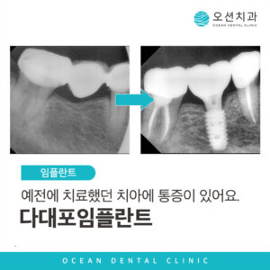 다대포임플란트